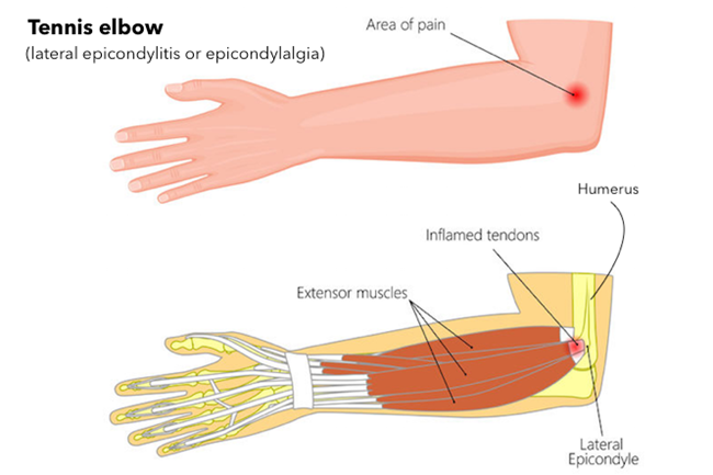 Natural Ayurvedic Home Remedies for Tennis Elbow (Tendonitis)