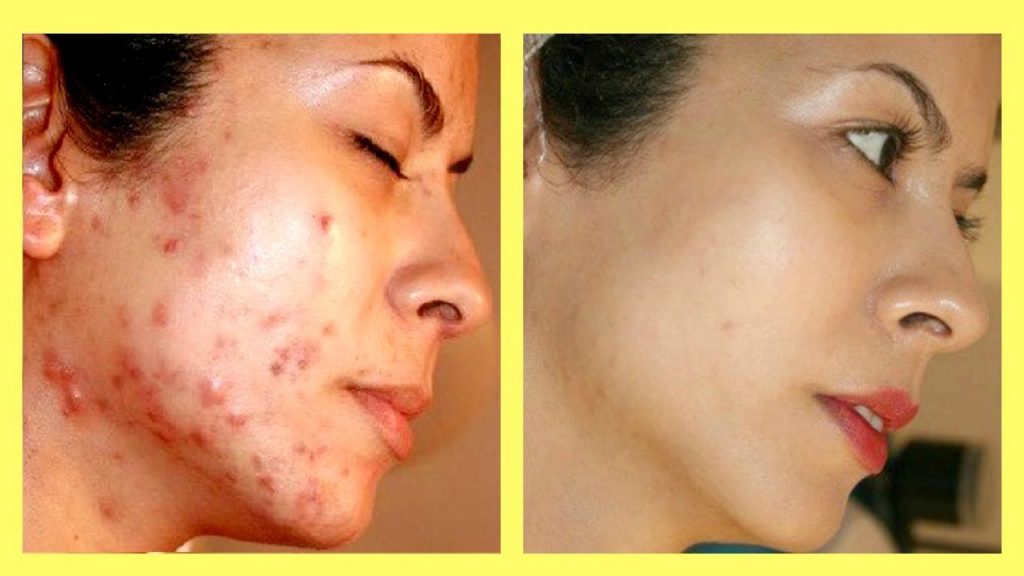 Women acne before and after photo