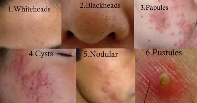 How to get rid of Blackheads